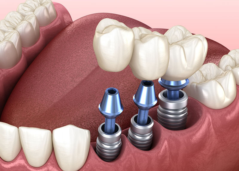 Dental-implants-graphic-1
