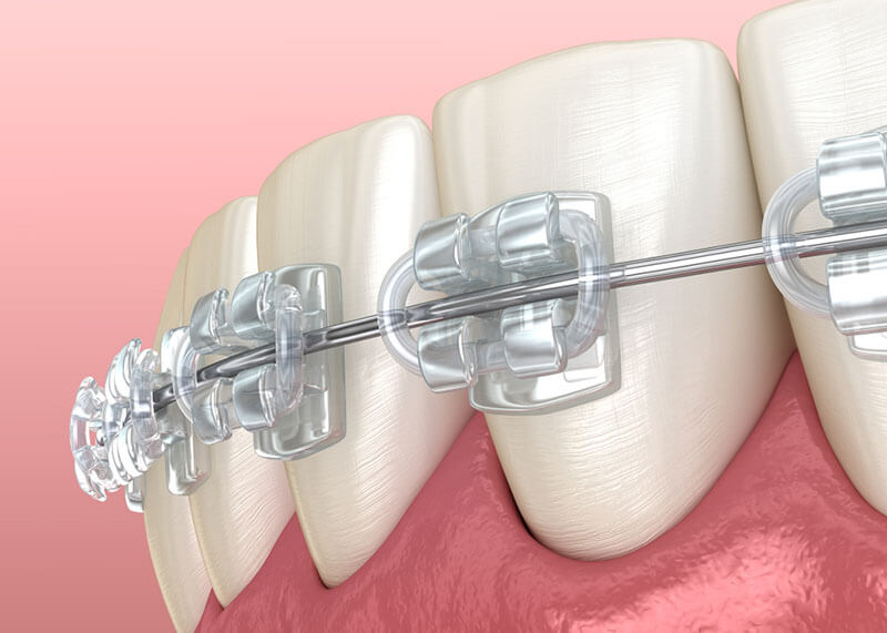 braces-on-teeth-graphic