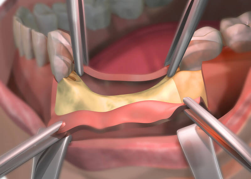 oral-surgery-graphic