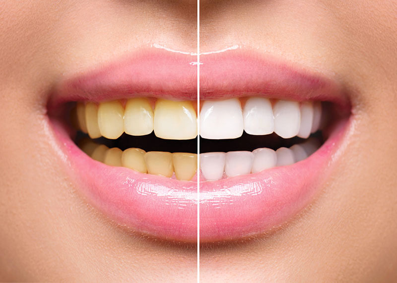 teeth-whitening-before-and-after-womans-smile