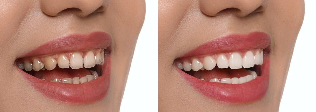 before and after dental veneers treatment on white background