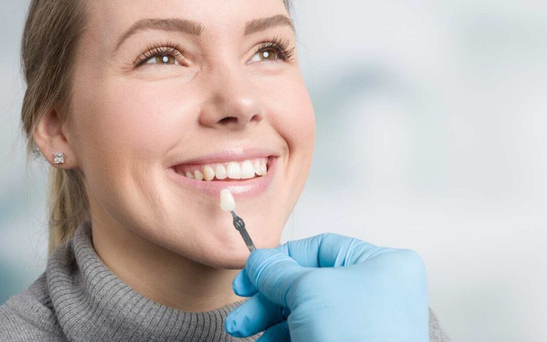 dentist using shade guide at mouth of a woman to check veneer of tooth