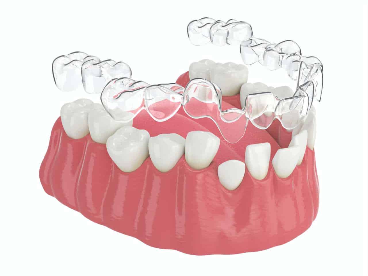 Does Invisalign Work Insights From A Professional Dentist