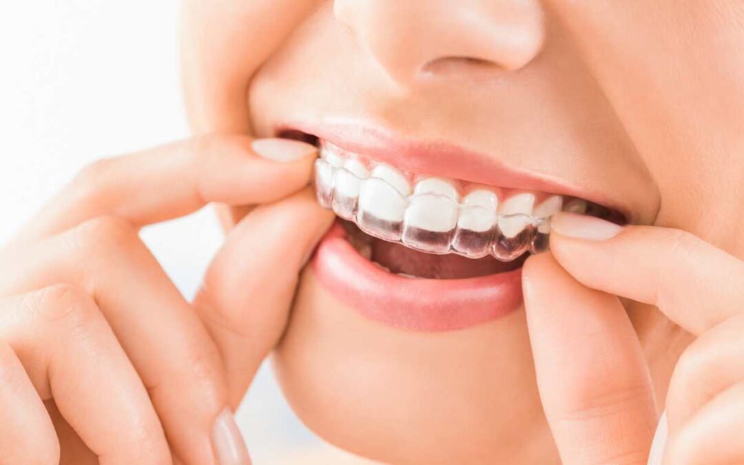 Invisalign Braces For Teeth Straightening: Does It Really Work?