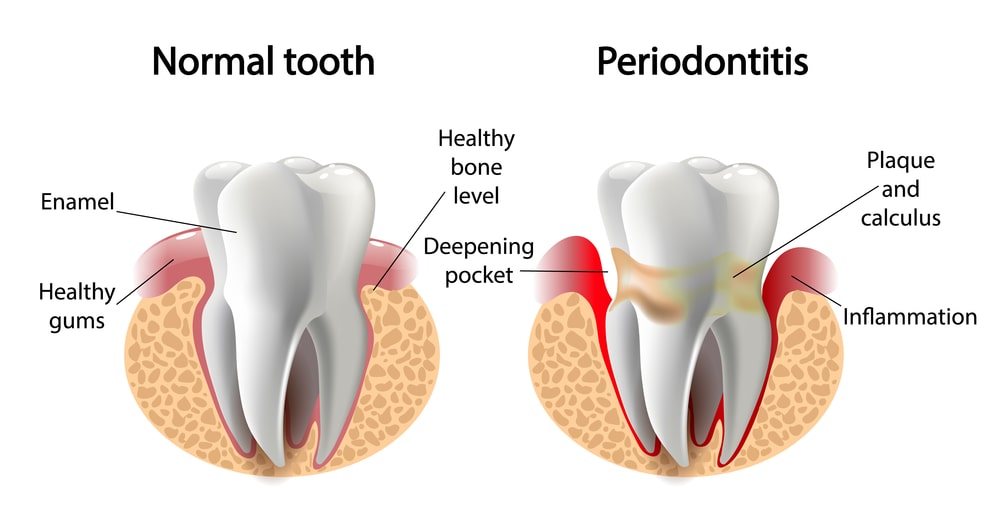root-canal-therapy-graphic