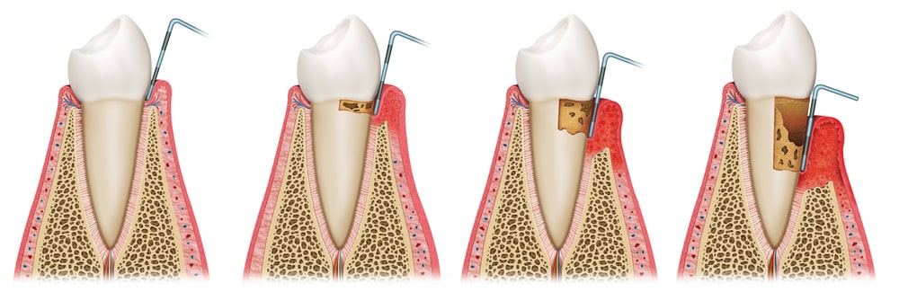 Man-smiling-in-dental-chair